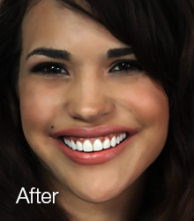 dental veneers after shot of girl one