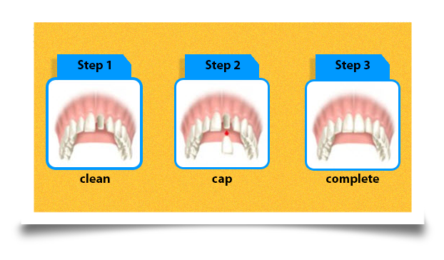 crowns-and-bridges-figure-two